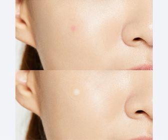 Acne Pimple Master 24 patches
